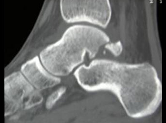 Do You Know About Fracture of the Neck of Talus?