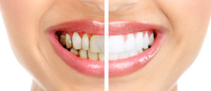 What are the Benefits of Laser Treatment For Gum Disease