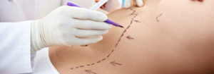 Liposuction Fat Removal